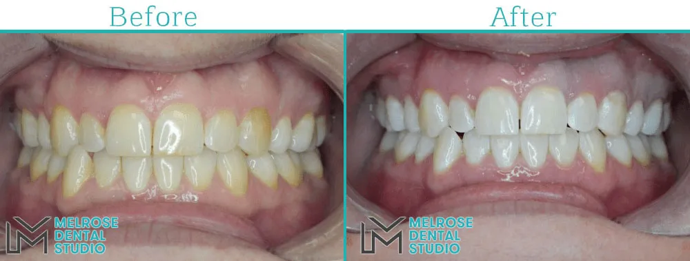 Teeth whitening before and after result, case 5, Melrose Dental Studio